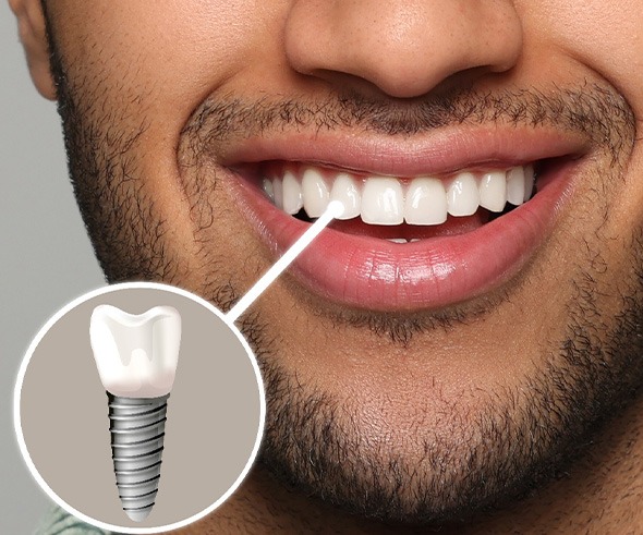 Nose-to-neck image of man smiling with a tooth indicated as an implant