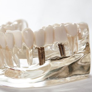 Dental implant bridge in plastic model of mouth