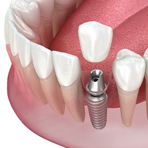 Illustration of single dental implant
