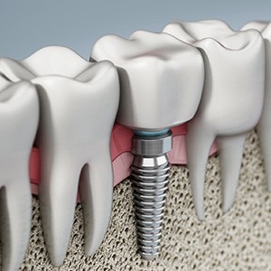 Illustration of a single dental implant in the jawbone