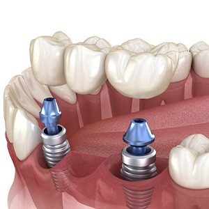 Illustration of implant bridge