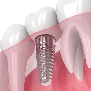 Illustration of single dental implant with a crown between natural teeth