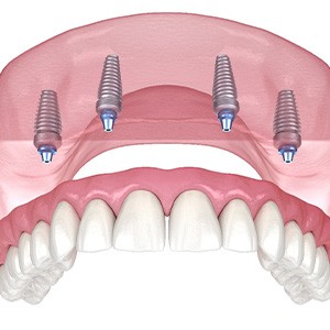 Illustration of an implant denture