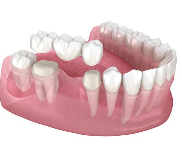 Illustration of traditional dental bridge being placed on prepared teeth