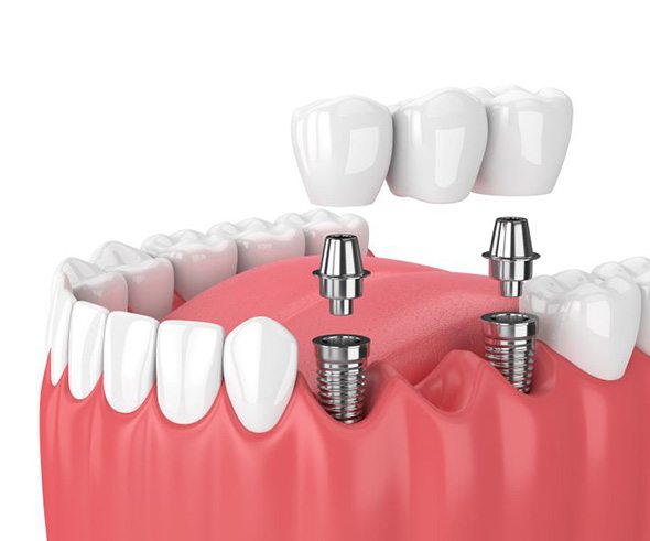 Illustration of three-unit dental implant bridge