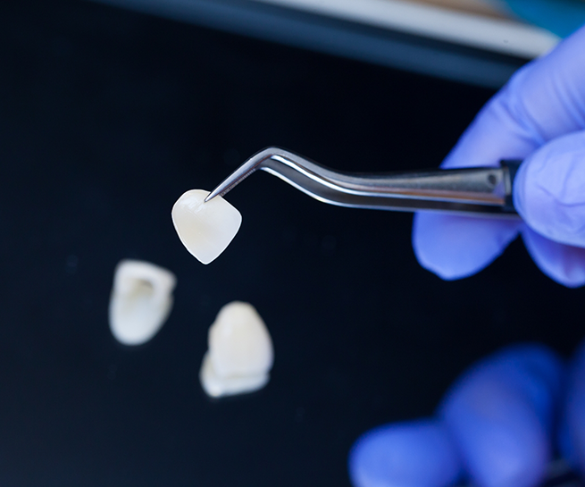 Dentist holding a veneer with a set of tweezers