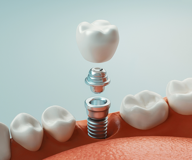 Illustration of a dental implant and crown replacing a missing lower tooth