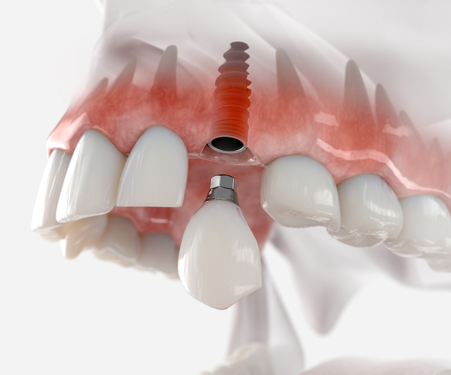 Illustration of a dental implant being placed in the upper jaw to replace a tooth