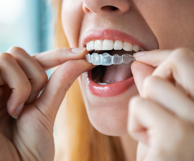 Close up of a blonde woman placing an Invisalign aligner over her teeth