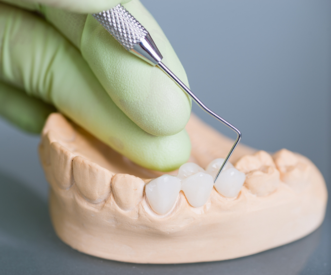 Dentist adjusting a dental bridge replacing three teeth in a model of the mouth