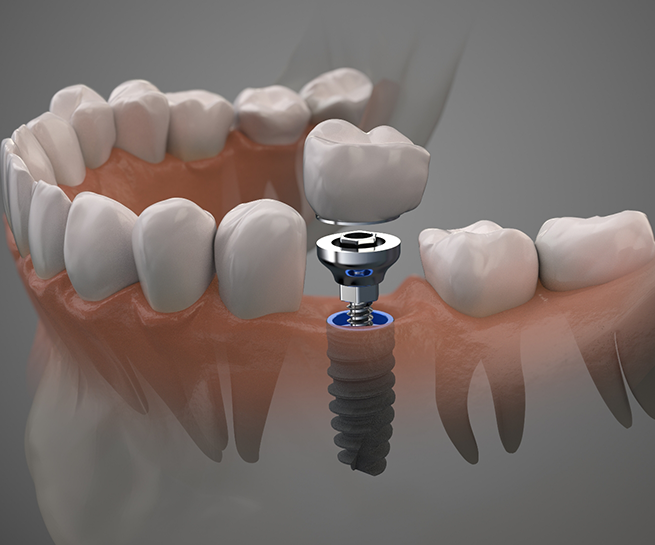 Illustration of a dental implant in the lower jawbone replacing a missing tooth