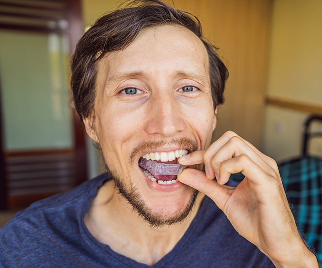 Man placing a clear nightguard tray over his teeth