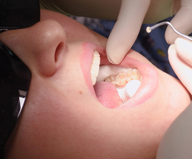 Dentist placing a white filling in a tooth