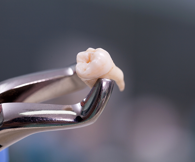 Close up of dental forceps holding an extracted tooth