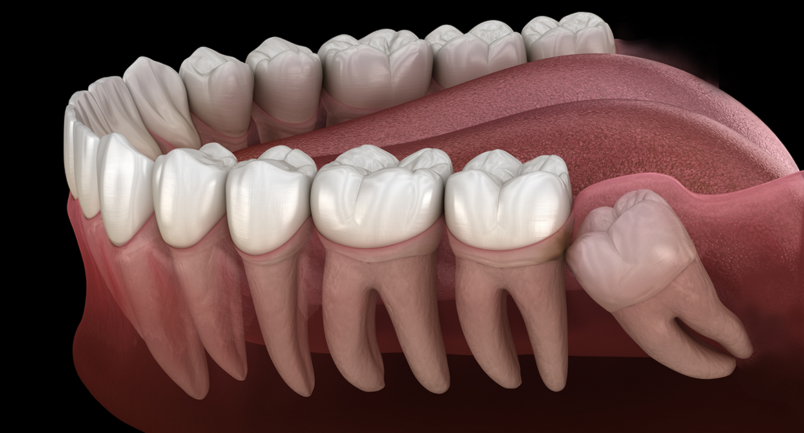 Illustration of an impacted wisdom tooth pressing against the adjacent tooth