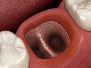 Rendering of dry socket.