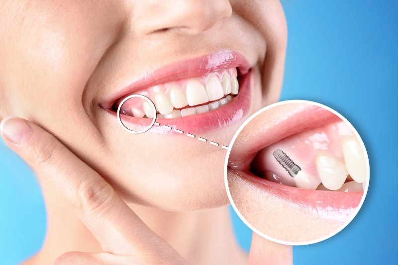 A photo highlighting a woman’s completed dental implant